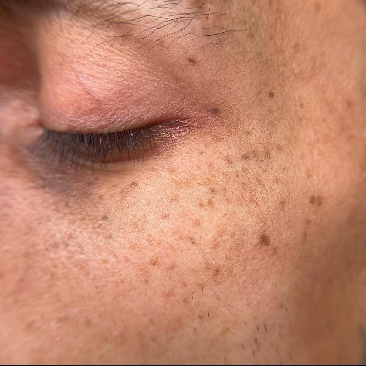 03 Freckles
